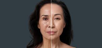 Experience the Power of EXION Treatment in Clermont, FL