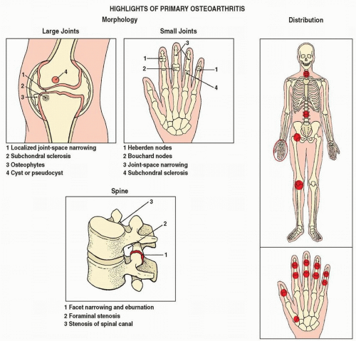 Degenerative Joint Disease ICD 10 Code: A Complete Guide