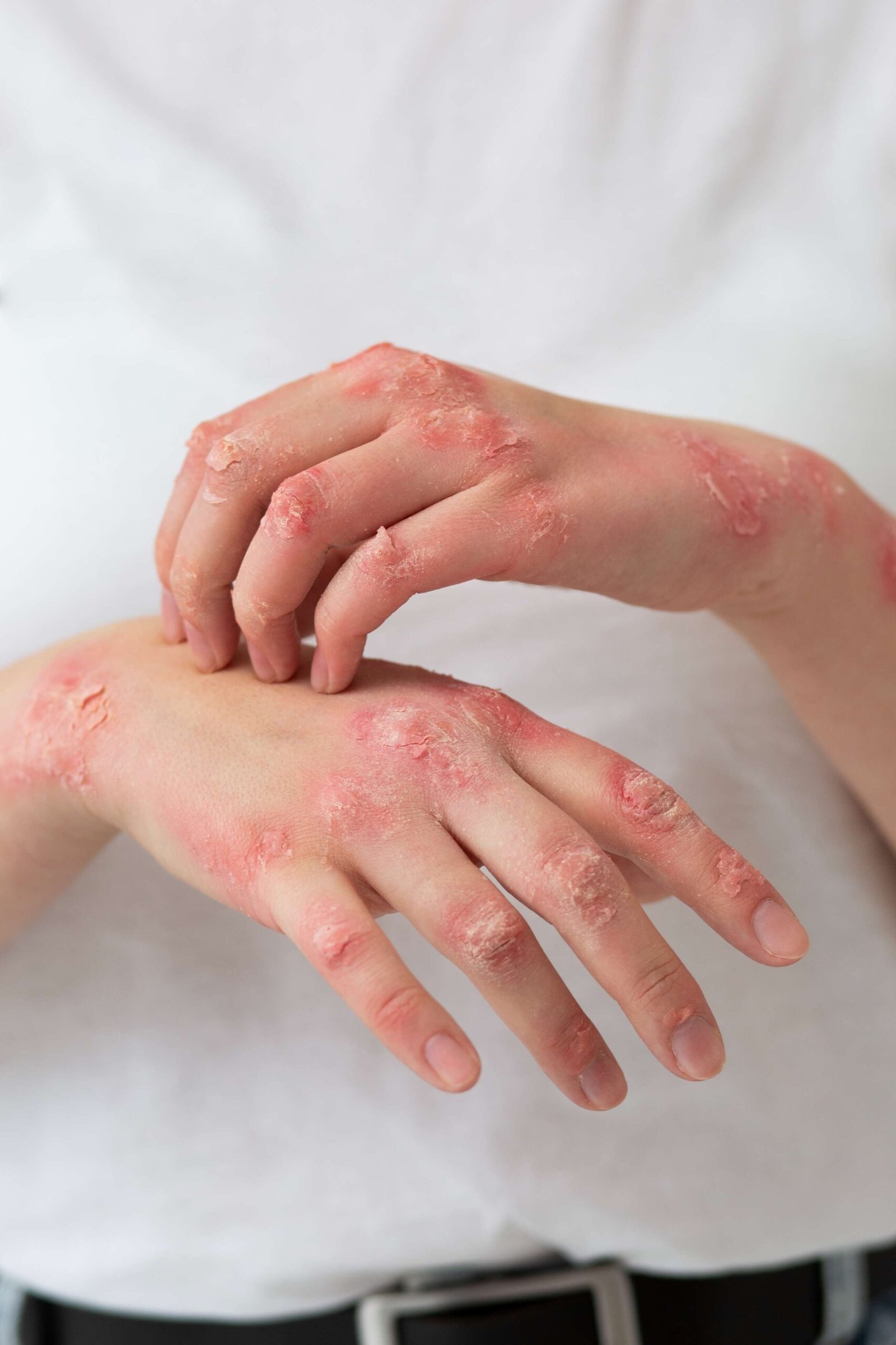Ivercor 12mg: A Small Pill Making a Big Difference in Health