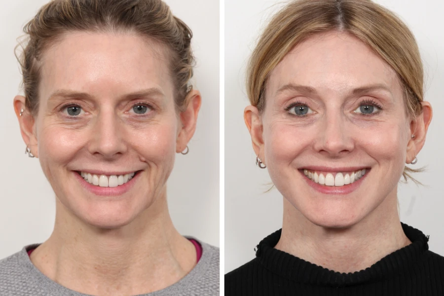 When it comes to non-surgical facial rejuvenation, thread lift treatments in Dubai have become a top choice for those seeking subtle, natural-looking results with little to no downtime. Whether inspired by celebrity treatments in Dubai Thread lift in Dubai, or simply looking for a refreshed appearance, many individuals now prefer thread lifts over traditional facelift surgeries. But one of the most frequently asked questions is: How long do the results from thread lift treatments really last? In this article, we will explore the answer to that question, along with everything else you need to know to make an informed decision. We’ll also cover the types of threads used, factors that affect longevity, maintenance tips, and how choosing the best thread lift clinic Dubai and a skilled thread lift specialist Dubai can influence your outcome. What Is a Thread Lift? A thread lift is a minimally invasive cosmetic procedure that uses dissolvable threads to lift and tighten sagging skin. It offers an alternative to surgery for those who want visible improvement in their facial features without going under the knife. During a thread lift treatment Dubai, fine threads are inserted under the skin using a small needle. These threads anchor and lift the skin while stimulating natural collagen production. The result is firmer, more youthful-looking skin. Popular areas for a thread lift for face Dubai include: Jawline Cheeks Brows Neck Nasolabial folds (smile lines) Types of Threads and Their Lifespan There are several types of threads used in thread lift treatments in Dubai, and each one has its own duration and effect: PDO Threads The most commonly used option is the PDO thread lift Dubai. These threads are made of Polydioxanone, a safe and absorbable material used in medical sutures. Dissolve in: 4 to 6 months Results last: 12 to 18 months Best for: Mild to moderate sagging, collagen stimulation PLLA Threads PLLA (Poly-L-Lactic Acid) threads last longer and offer a stronger lifting effect. Dissolve in: 12 to 18 months Results last: 18 to 24 months Best for: Moderate to deeper skin laxity, volume loss PCL Threads PCL (Polycaprolactone) threads are the longest-lasting of all. Dissolve in: Up to 24 months Results last: 24 to 36 months Best for: Significant sagging, long-term skin tightening Choosing the right type of thread often depends on your age, skin condition, and the area being treated. A qualified thread lift specialist Dubai can help select the right option for your goals. How Long Do the Results Last? The longevity of results from a thread lift in Dubai depends on several factors: 1. Type of Thread Used As mentioned, PDO thread lift Dubai results last about 12 to 18 months, while PLLA and PCL threads can last up to 2–3 years. 2. Area Treated Some areas of the face and neck may hold the threads better than others. For example, thread lifts on the jawline or cheeks may last longer than those on the forehead or under the eyes. 3. Skin Quality If your skin is already healthy and firm, the results are likely to last longer. Thinner, more fragile skin may show changes sooner. 4. Lifestyle and Habits Smoking, excessive alcohol consumption, poor diet, and high stress can break down collagen faster, shortening the results. On the other hand, a healthy lifestyle can help maintain your lift for a longer time. 5. Age Younger clients often see longer-lasting effects as their skin still has natural collagen support. Older individuals may require more frequent maintenance. What Do the Results Look Like Over Time? After your thread lift treatment Dubai, results are visible immediately and continue to improve over time. 1 Week: Initial swelling goes down, and the lift becomes more visible. 1 Month: Threads begin stimulating collagen, enhancing skin texture. 3–6 Months: Peak collagen production. Skin looks firmer and lifted. 12 Months+: Threads dissolve naturally, but collagen support remains. 18–24 Months: Gradual fading of results. Maintenance may be needed. To maintain your refreshed look, many people return to the best aesthetic clinic in Dubai for touch-ups once a year or every 18 months. Thread lifts offer a middle ground between short-term solutions like fillers and long-term surgical options, making them ideal for those who want a natural, yet noticeable improvement without a big commitment. Maintenance and Touch-Ups While thread lifts don’t offer permanent results, they are easy to maintain. A few tips to extend your results: Follow proper aftercare advice Stay hydrated and maintain a healthy diet Use sunscreen to protect your skin Avoid smoking and excessive alcohol Consider yearly touch-ups at the best thread lift clinic Dubai Many clients include thread lifts in their regular beauty plan, similar to how others treat Botox or fillers. How Much Does It Cost to Maintain Results? The thread lift cost in Dubai varies depending on the area treated, number of threads used, and thread type. Below is a rough cost guide. Remember, while thread lift cost Dubai can vary, it’s worth investing in the best thread lift clinic Dubai for safe and satisfying results. Are the Results Worth It? Absolutely. For people who want to: Lift sagging skin Avoid surgery Improve facial contours Reduce lines and wrinkles Follow celebrity treatments in Dubai Thread lift in Dubai trends Look naturally refreshed Thread lifts are an effective, non-invasive solution. When performed by an experienced thread lift specialist Dubai, the transformation can be subtle but highly satisfying, giving you a more youthful appearance with minimal effort. Final Thoughts So, how long do results from thread lift treatments in Dubai last? With PDO thread lift Dubai, expect results for 12 to 18 months. With PLLA or PCL threads, results can last up to 2–3 years. Lifestyle, age, and aftercare all play a role in maintaining results. A thread lift for face Dubai is a smart, non-surgical choice for people who want to look refreshed and youthful without the downtime of surgery. With the growing popularity of celebrity treatments in Dubai Thread lift in Dubai, it’s no surprise that more people are turning to this quick and effective solution. If you’re ready to lift and glow, choosing the best aesthetic clinic in Dubai and a certified thread lift specialist Dubai can make all the difference in your experience and results.