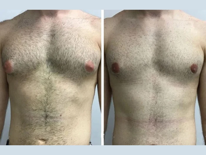 Why Reputation Matters: How to Find the Best Doctors in Dubai for Gynecomastia