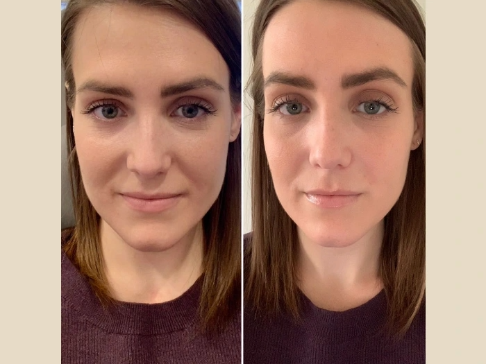 Best Aesthetic Clinic in Dubai for PRP Injection: Unlocking Skin Rejuvenation