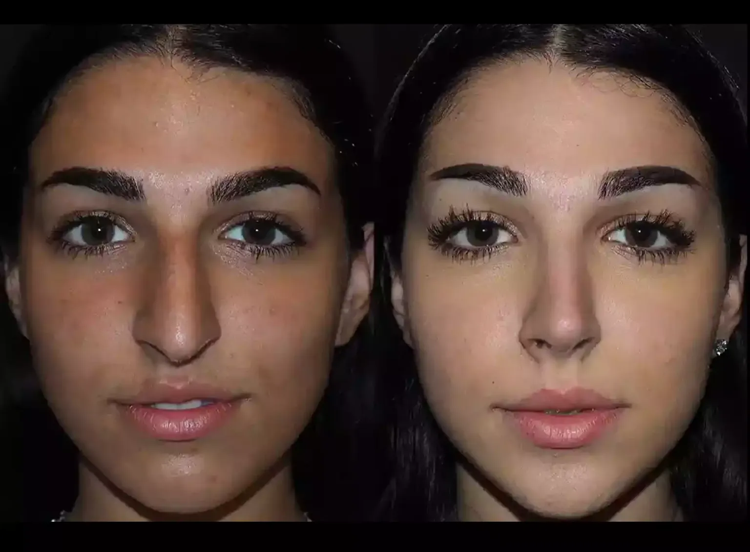 Breathing Better: Benefits of Septoplasty in Dubai