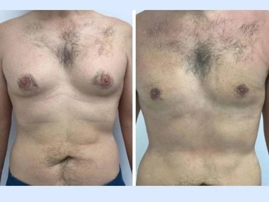 How to Book a Consultation for Gynecomastia in Dubai