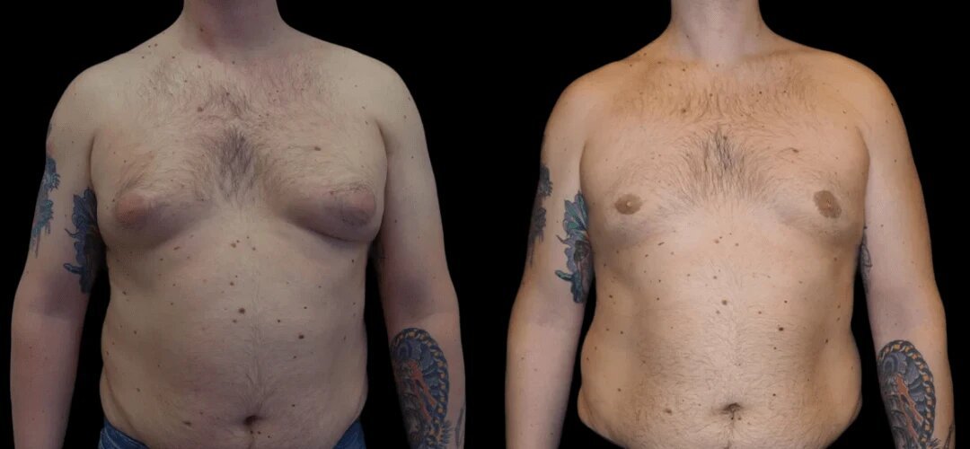 Best Gynecomastia Surgeon in Dubai: Trusted by Thousands of Men