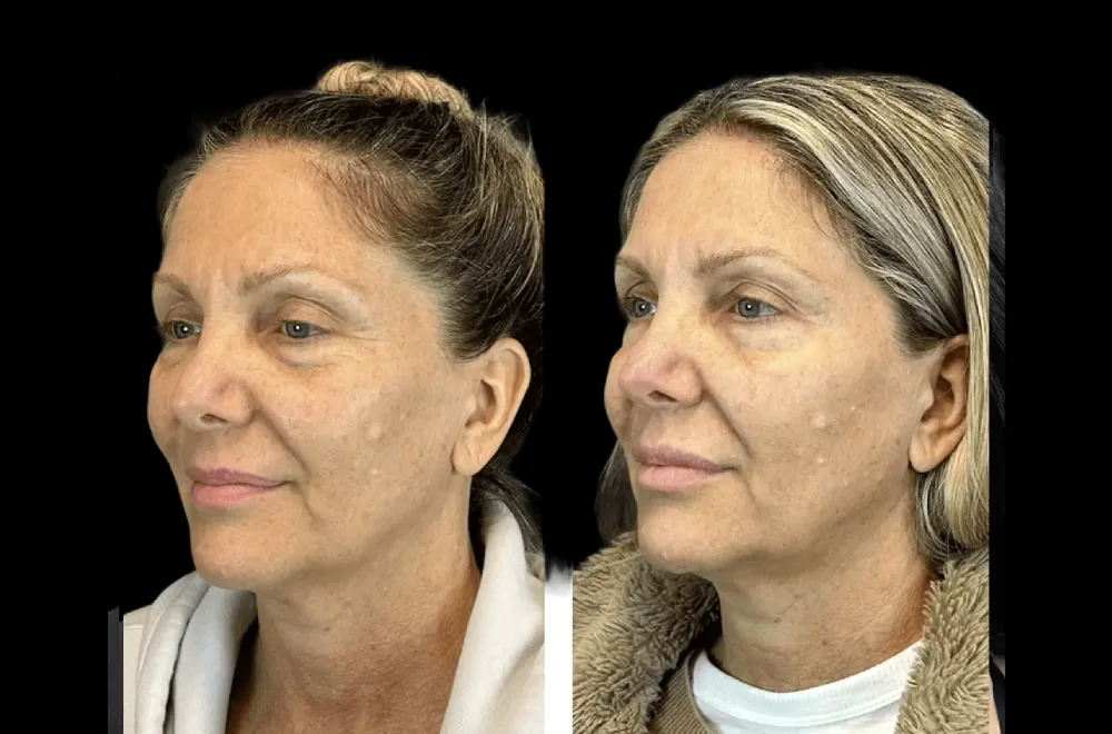 The Best Doctors in Dubai Reveal the Secret to Long-Lasting Botox Results