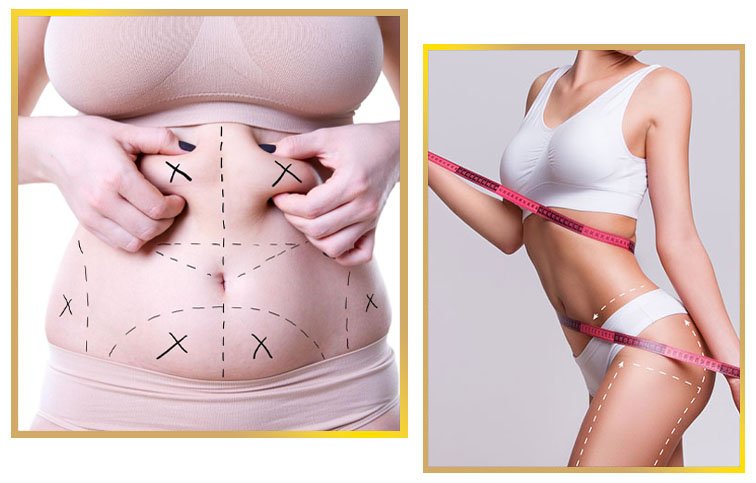 Liposuction in Islamabad