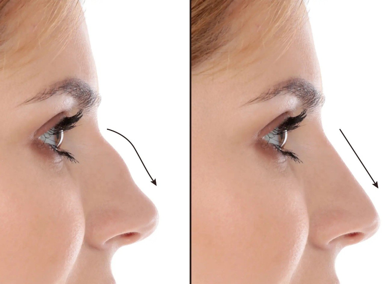rhinoplasty in dubai