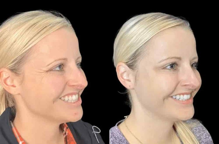 The Art of Subtle Rejuvenation with Botox in Dubai
