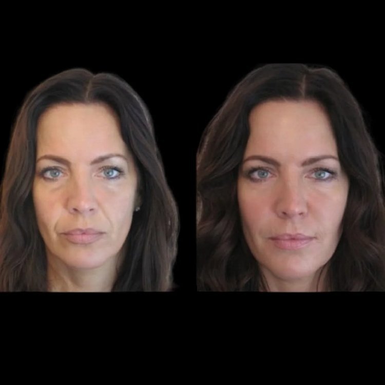Jawline Fillers in Dubai: How to Enhance Your Jawline Without the Downtime