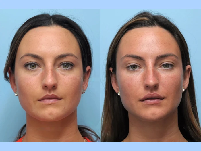 Restore Youthful Firmness with Thread Lift in Dubai